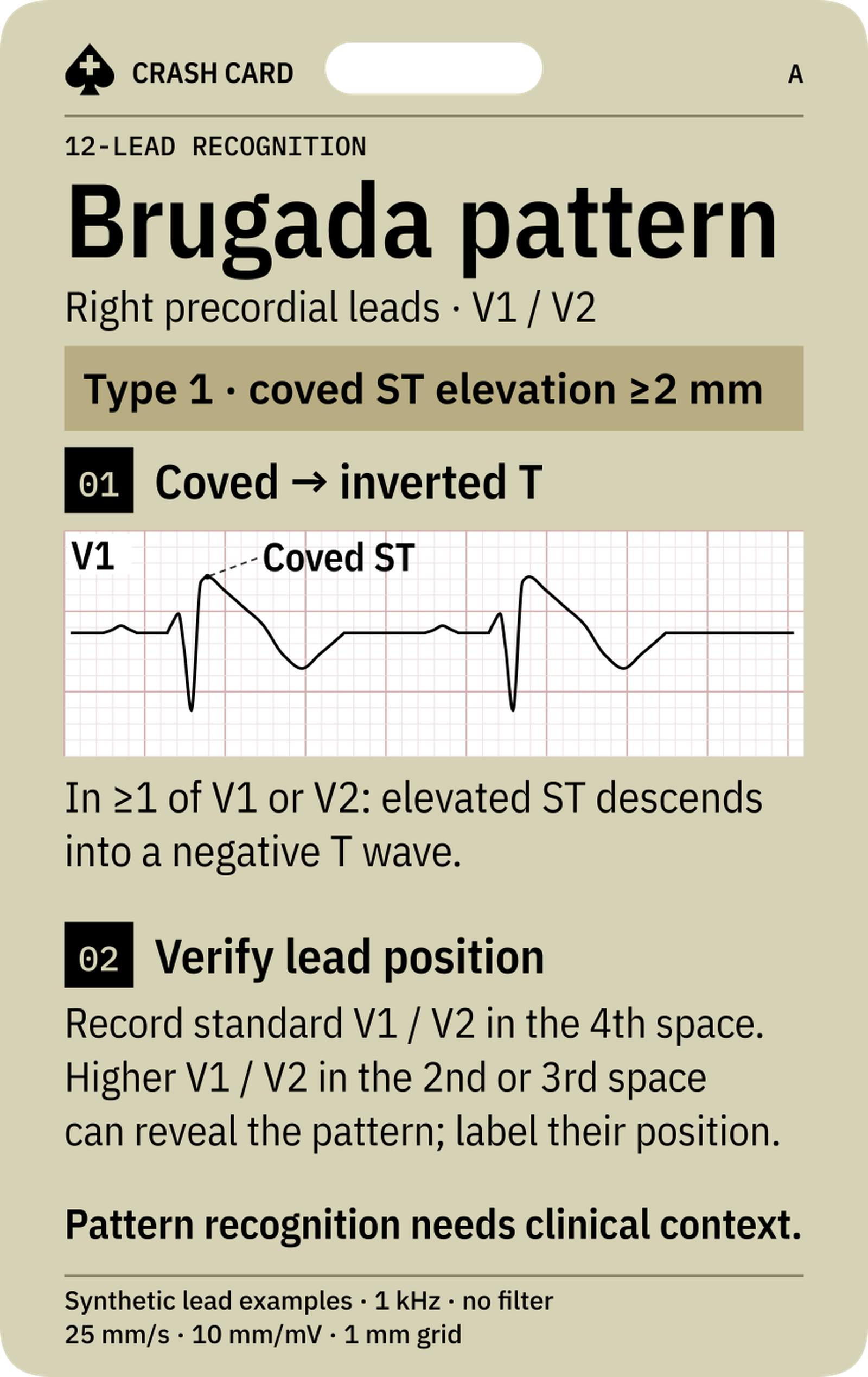Brugada Pattern Recognition — front: Type 1 and type 2 morphology pointers