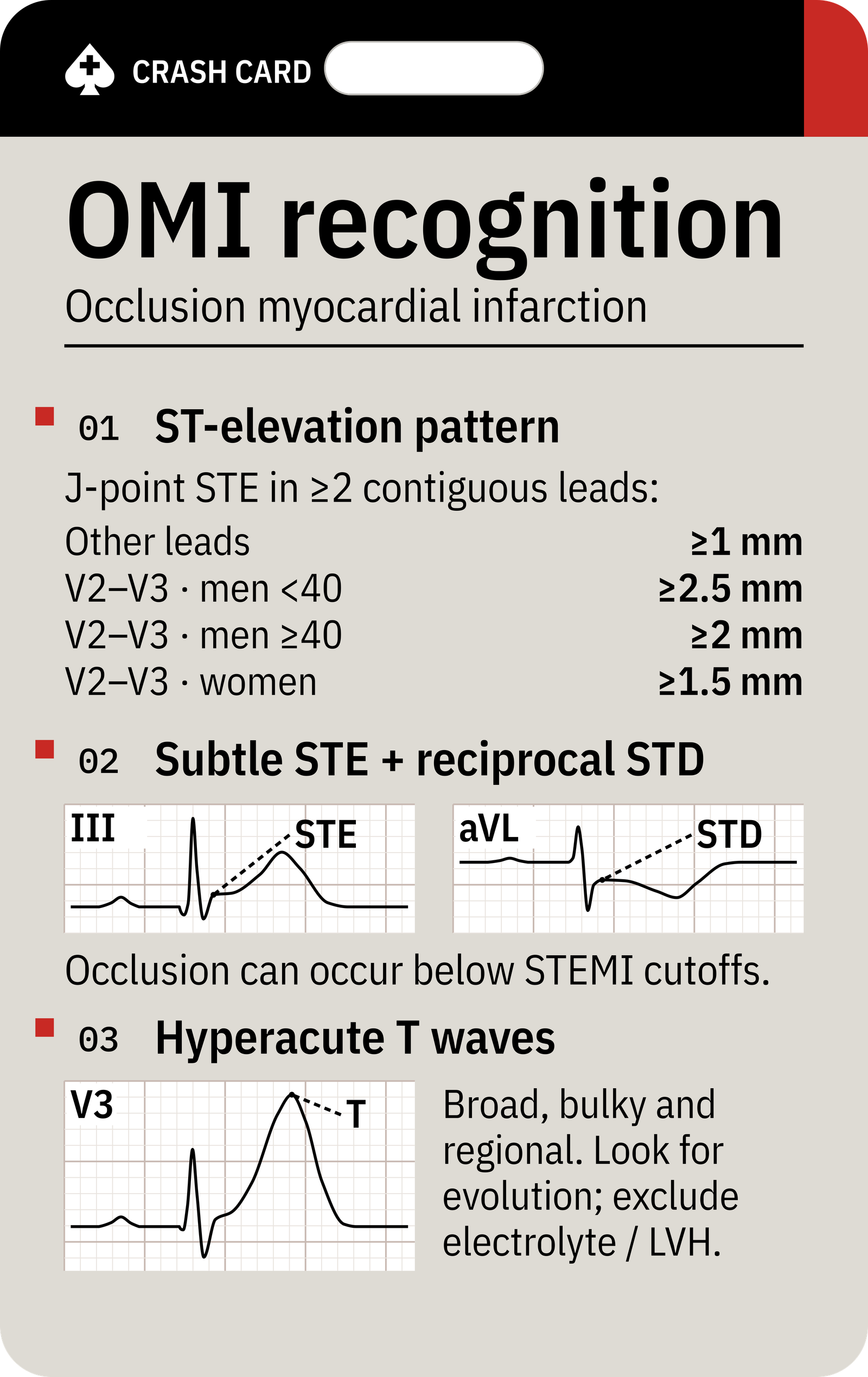 OMI Recognition — front: ST-elevation thresholds, reciprocal changes and hyperacute T waves