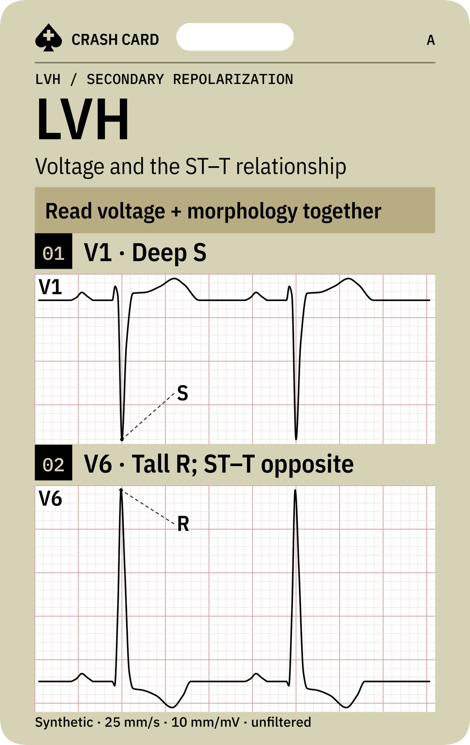 LVH & Secondary Repolarization — front: V1 S and V6 R waveform pointers