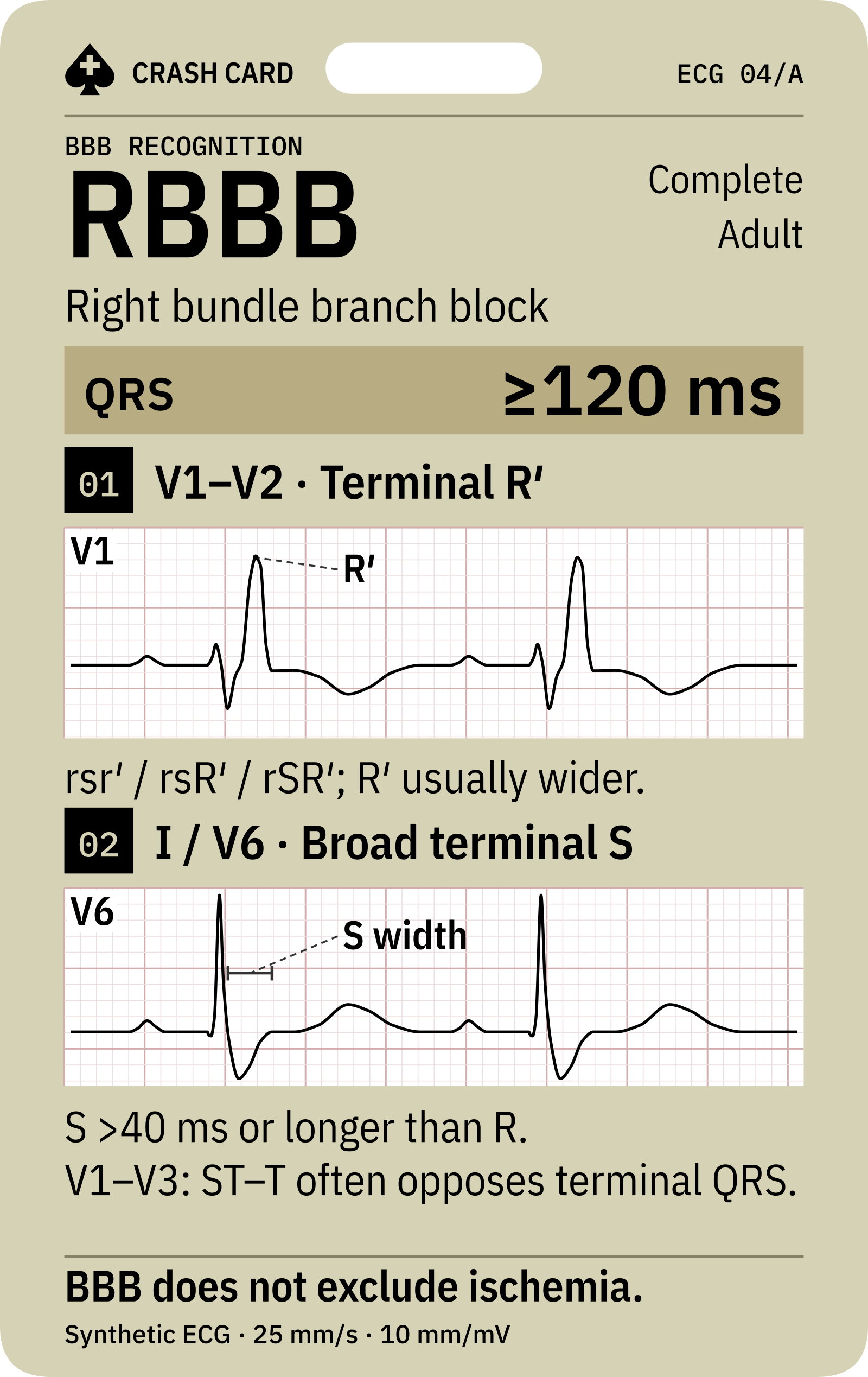 RBBB morphology in V1 and V6
