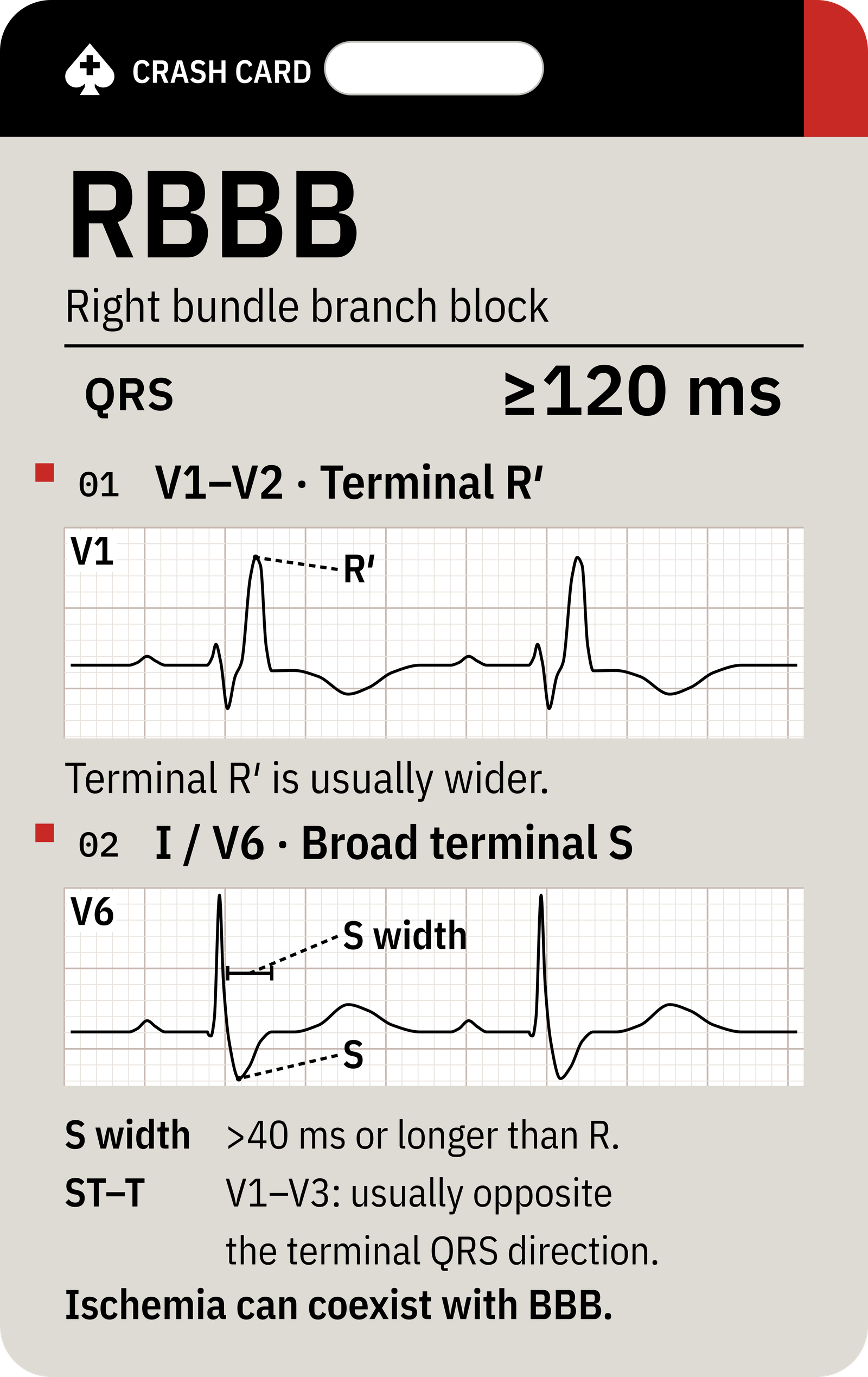 Bundle Branch Block Recognition — front: RBBB on the front: terminal R′ in V1–V2 and broad terminal S in I / V6