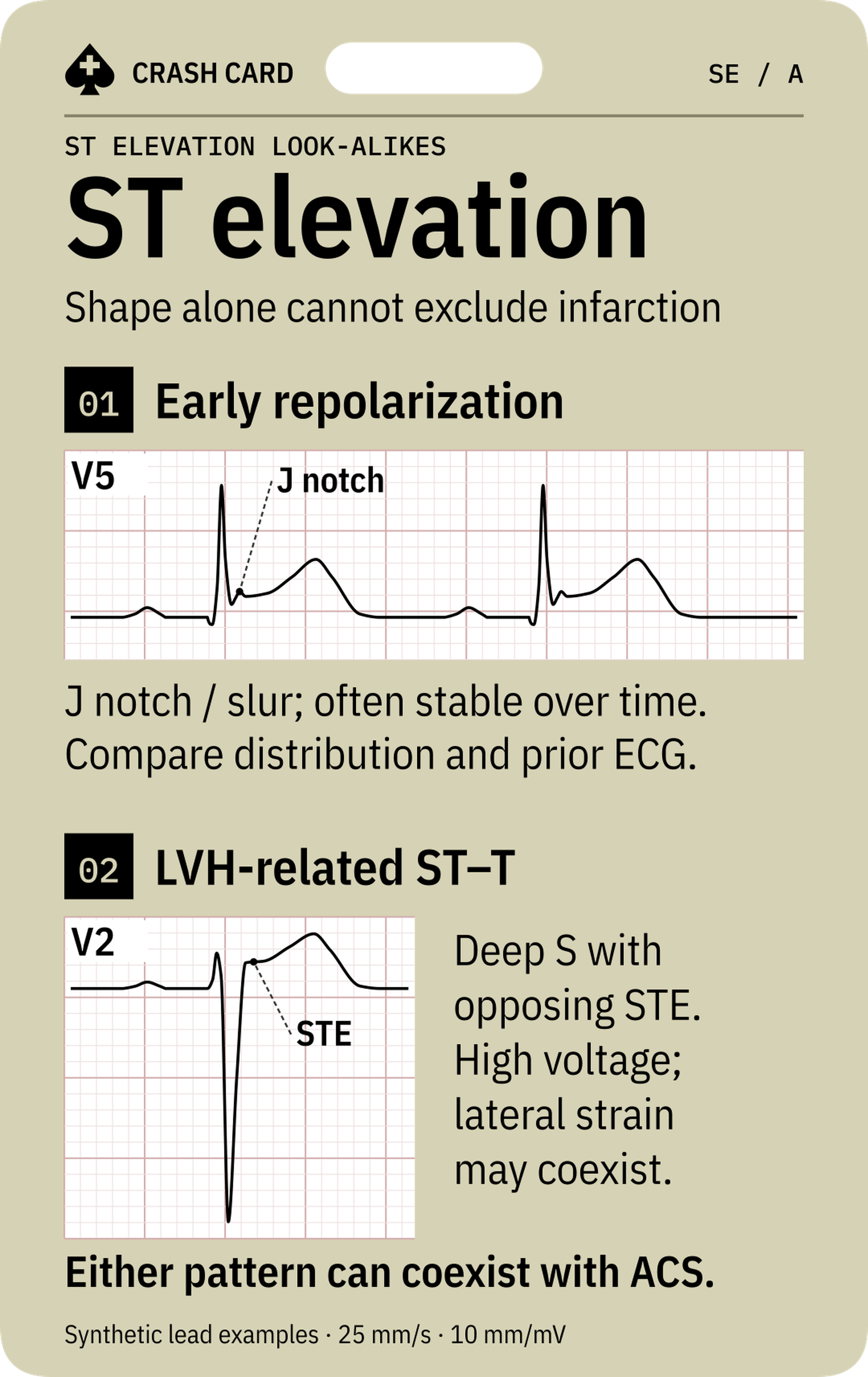 ST Elevation Look-alikes — front: Annotated J notch, ST elevation, PR depression and Q-wave examples