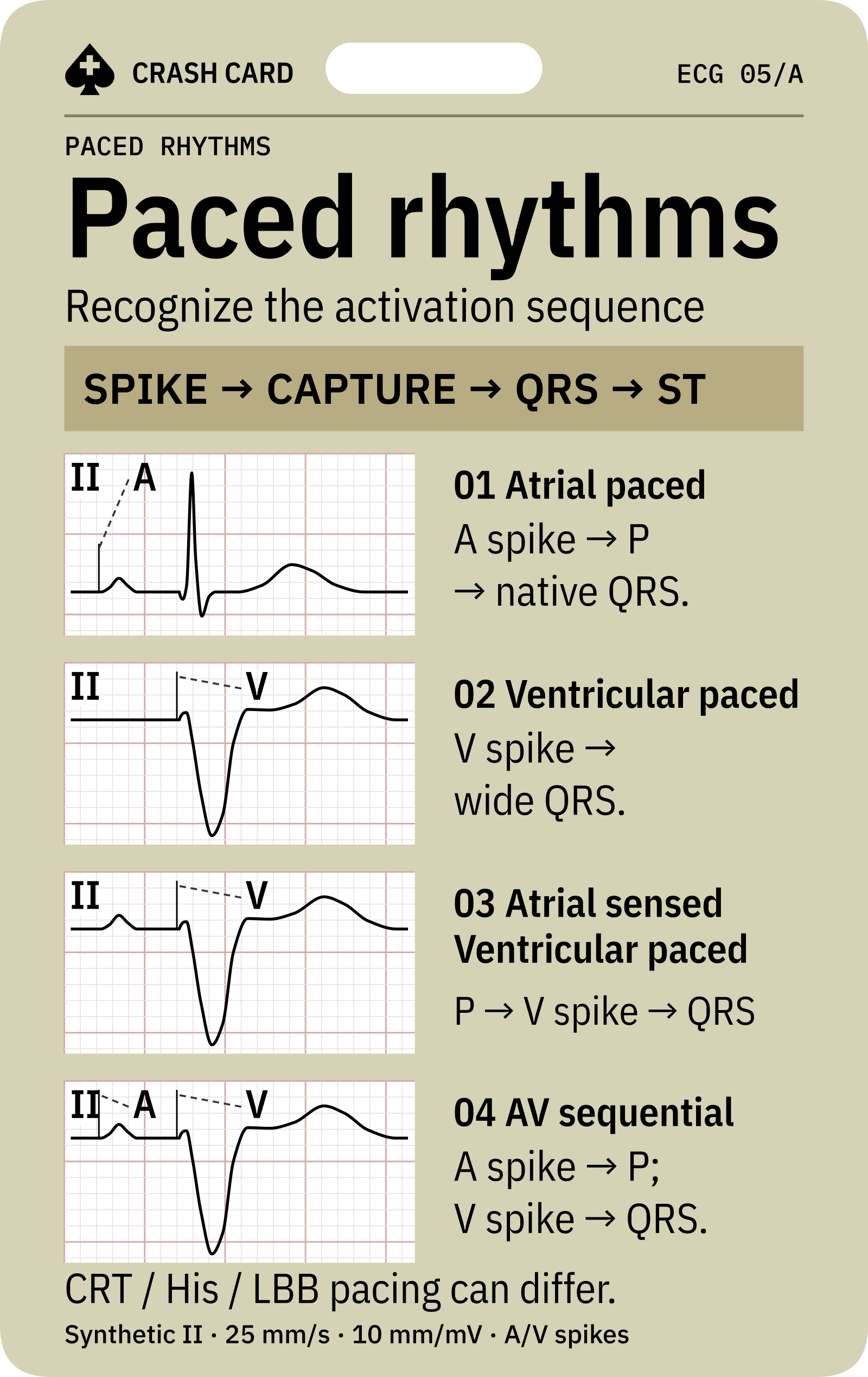 Four pacing patterns and their electrical sequence