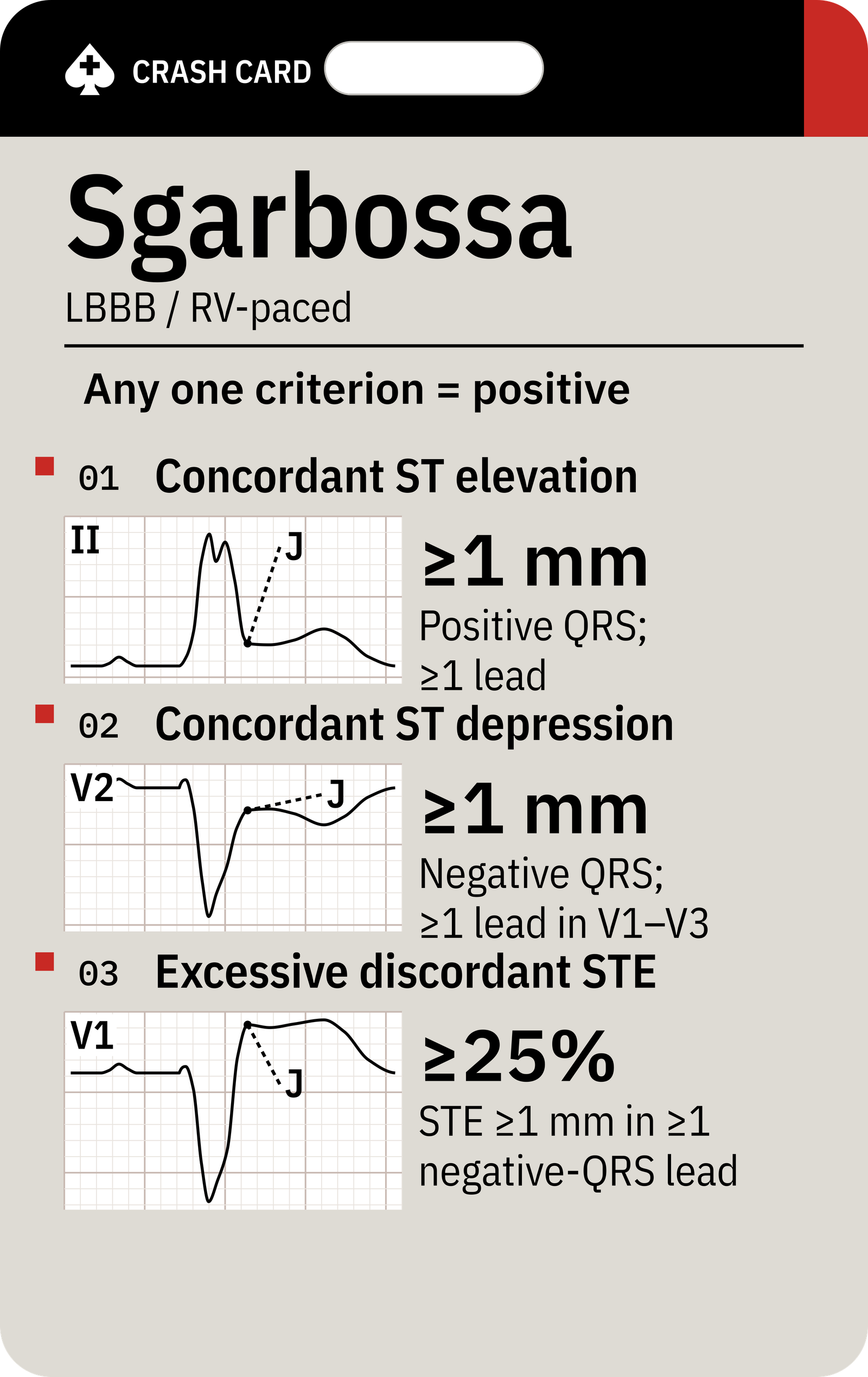 Smith-modified Sgarbossa — front: Concordant ST elevation, concordant ST depression, and excessive discordant ST elevation