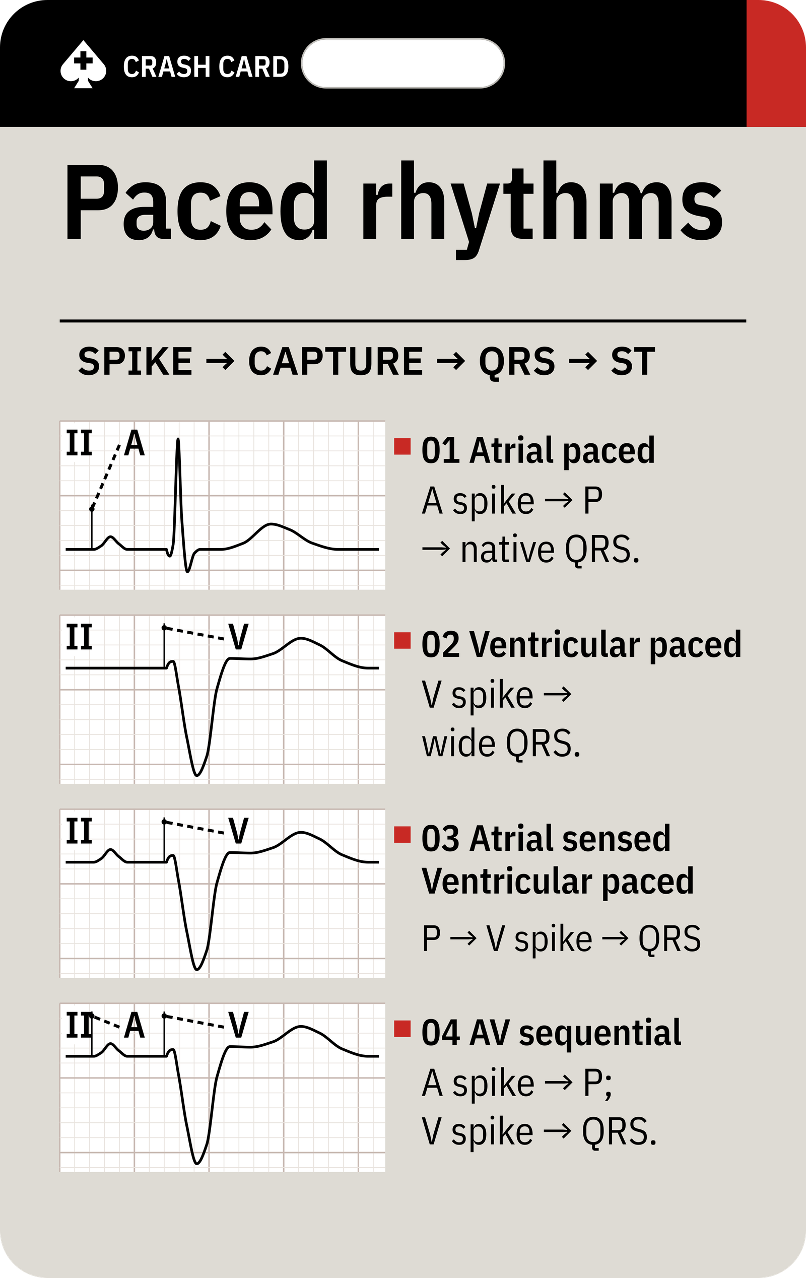 Paced Rhythm Recognition — front: Atrial, ventricular, atrial-sensed ventricular-paced, and AV sequential examples