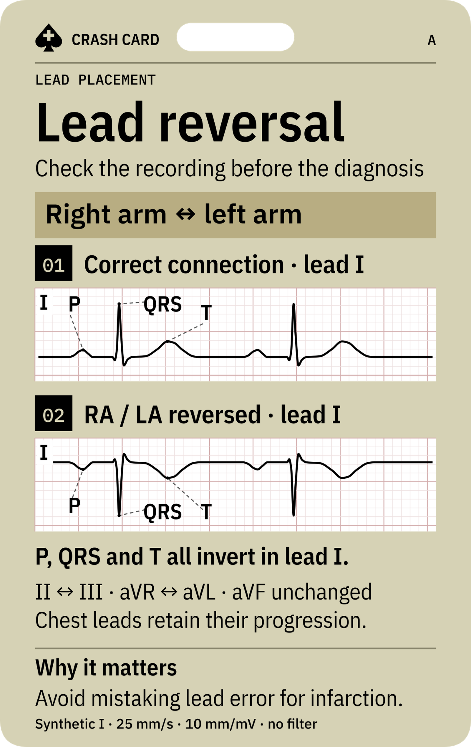 Lead Placement & Reversal — front: Normal and reversed lead I with P, QRS and T pointers