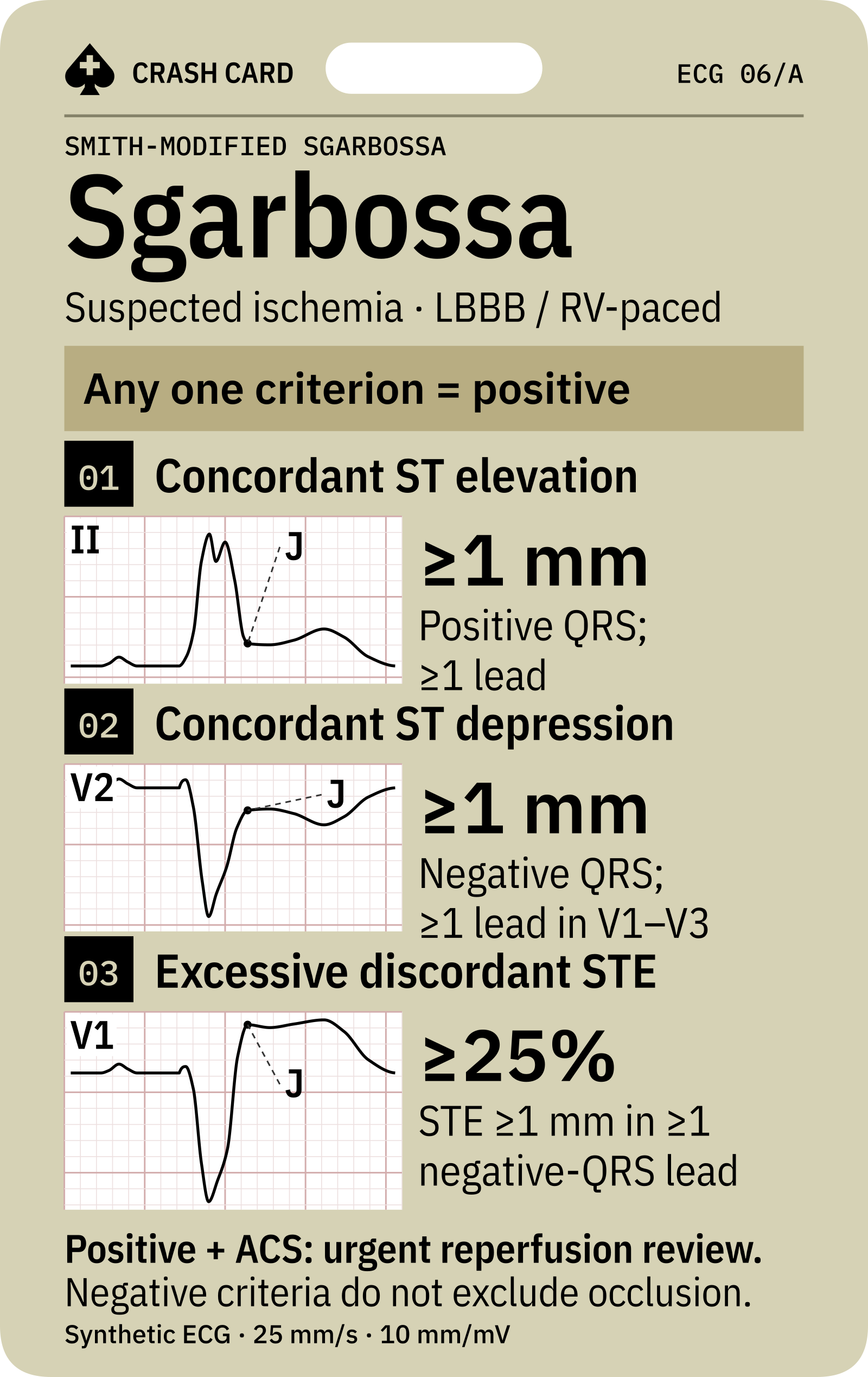 Smith-modified Sgarbossa: three criteria and thresholds