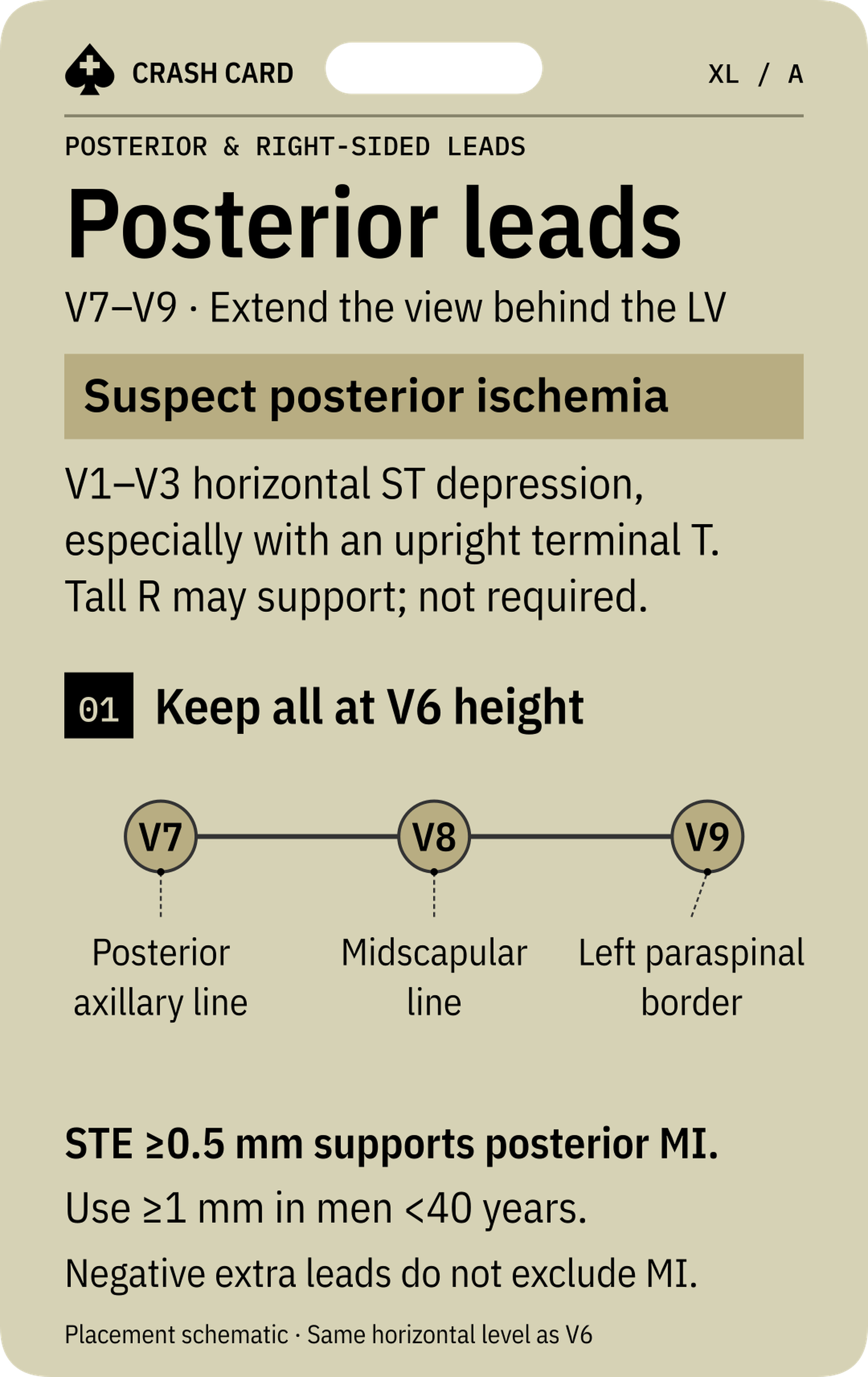 Posterior & Right-sided Leads — front: V7–V9 placement landmarks and posterior injury clues