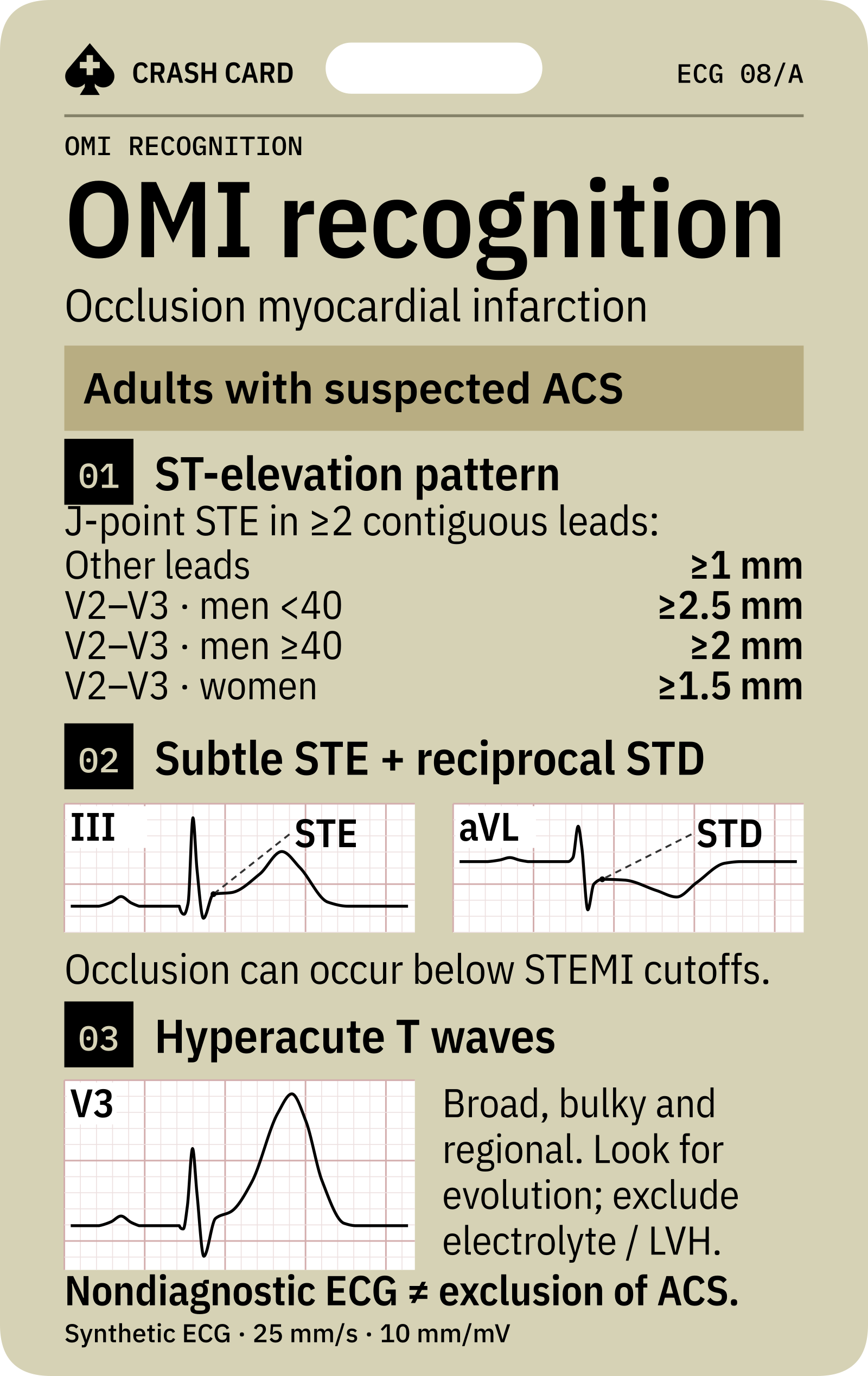 ST-elevation thresholds, reciprocal changes and hyperacute T waves