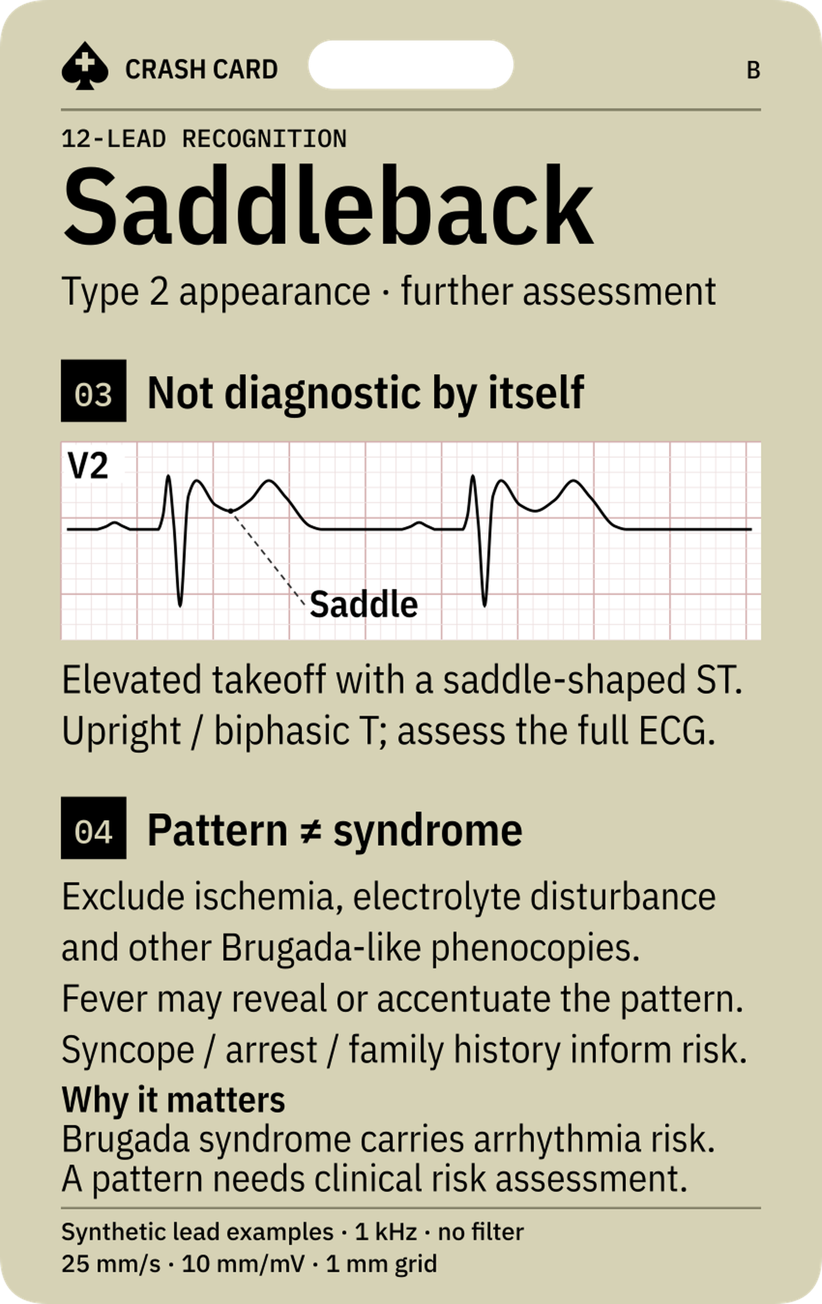 Brugada Pattern Recognition — back: Why a pattern requires clinical arrhythmia-risk assessment