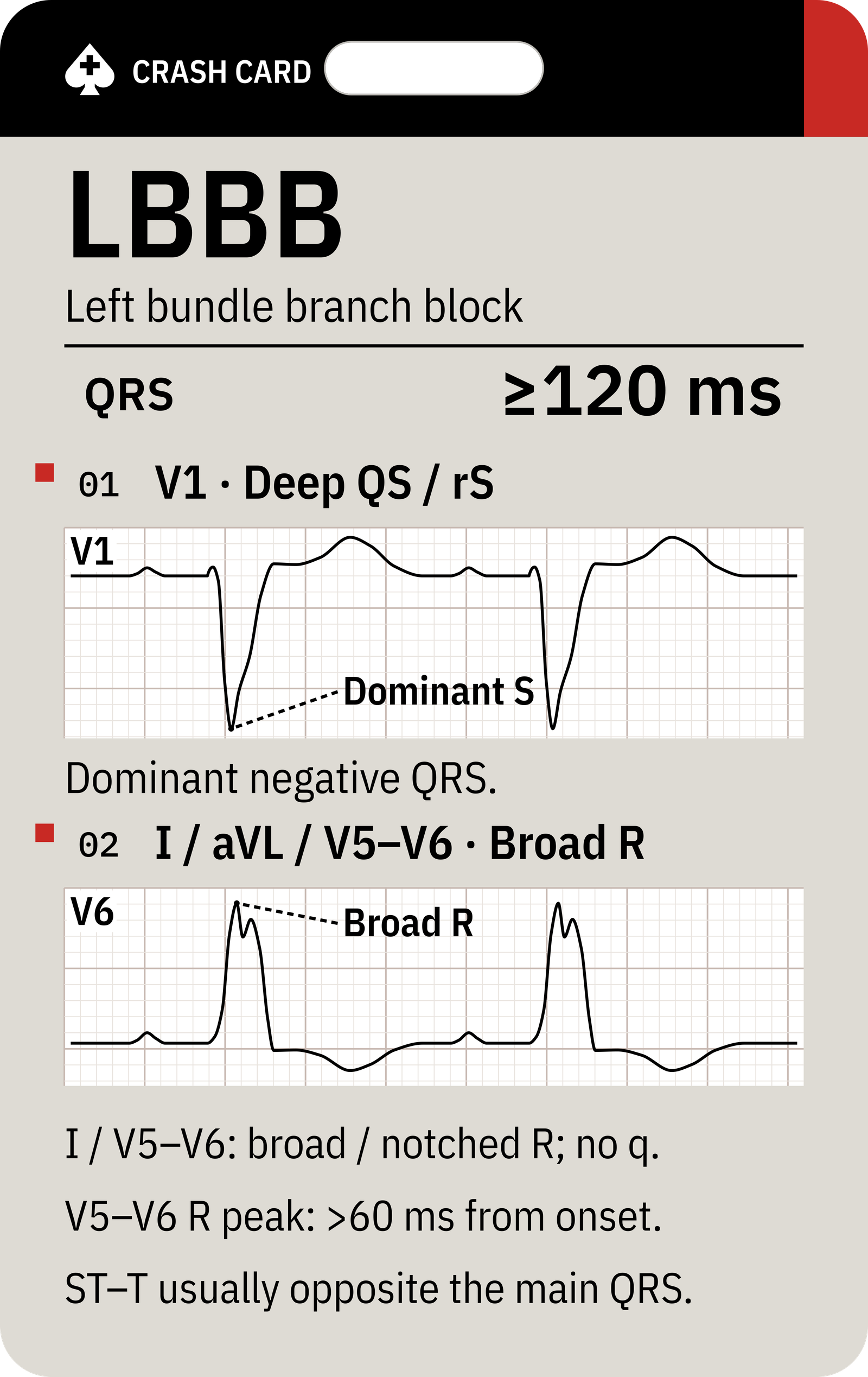 Bundle Branch Block Recognition — back: LBBB on the reverse: dominant negative V1 and broad lateral R waves