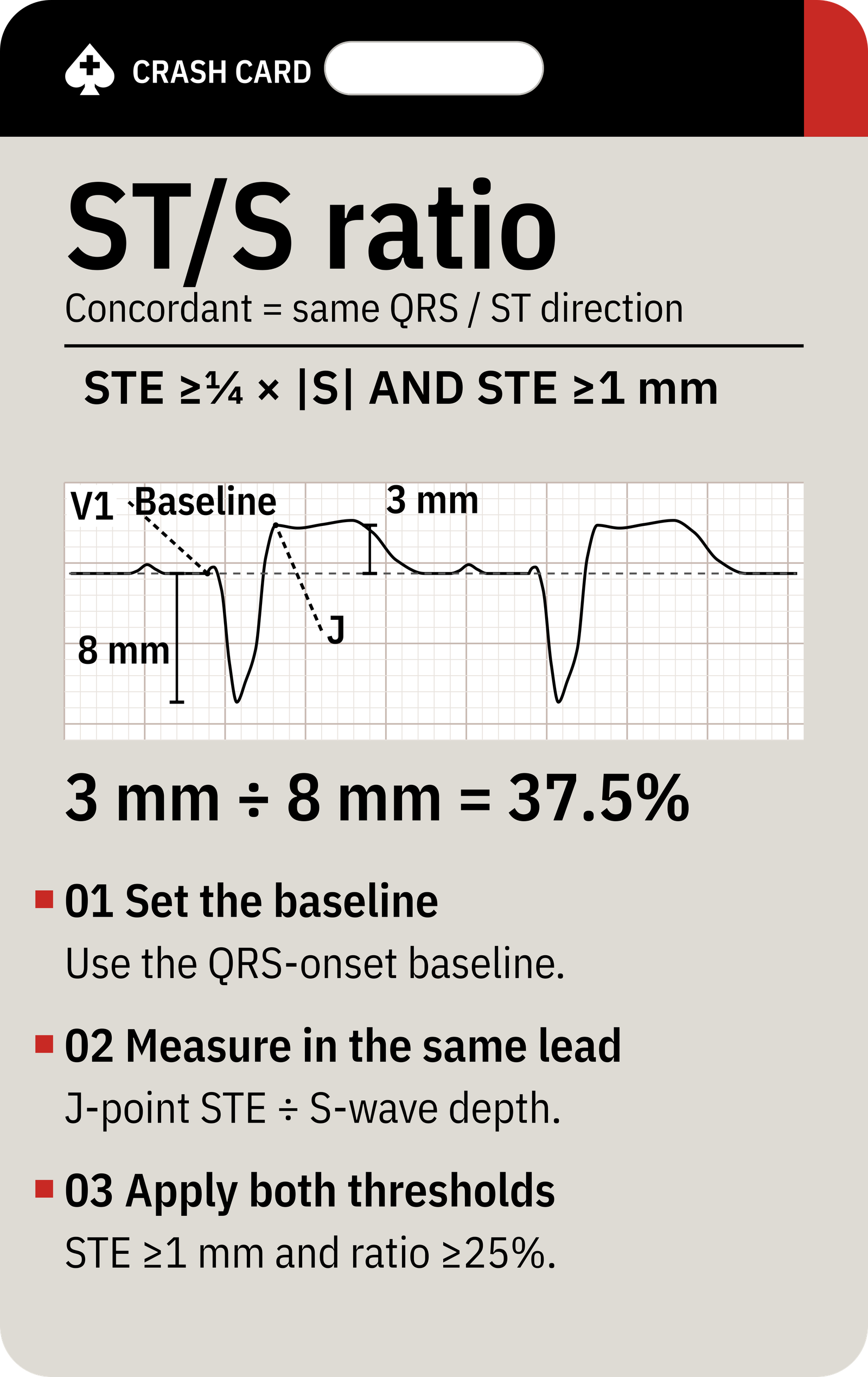 Smith-modified Sgarbossa — back: Reverse-side measurement guide: baseline, J-point, S-wave depth and a worked 3 ÷ 8 example