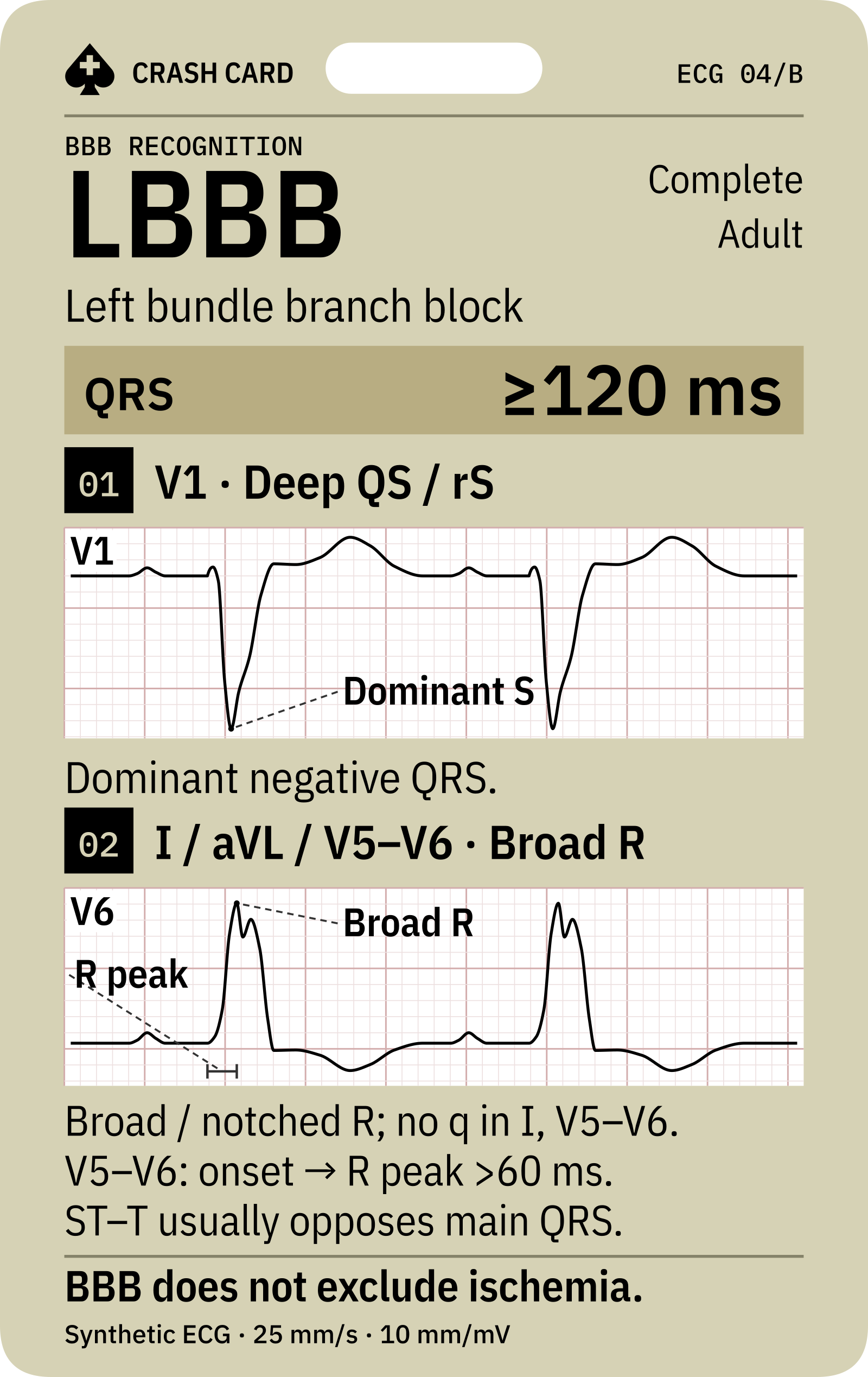 LBBB morphology in V1 and lateral leads