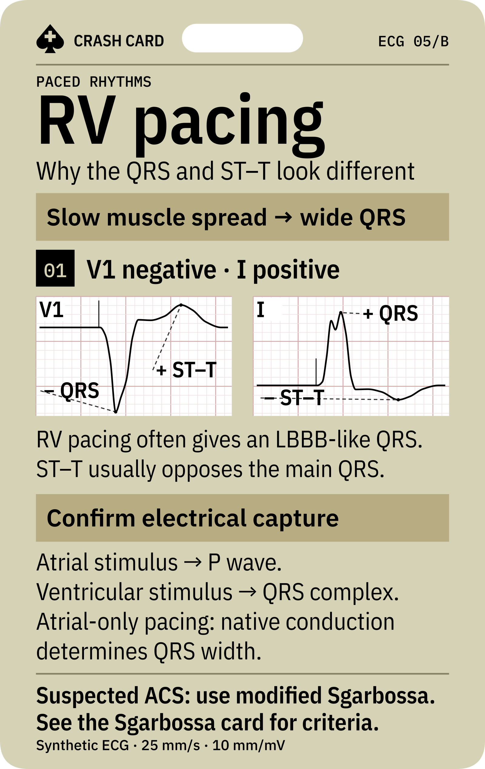 RV activation, electrical capture and the modified Sgarbossa connection