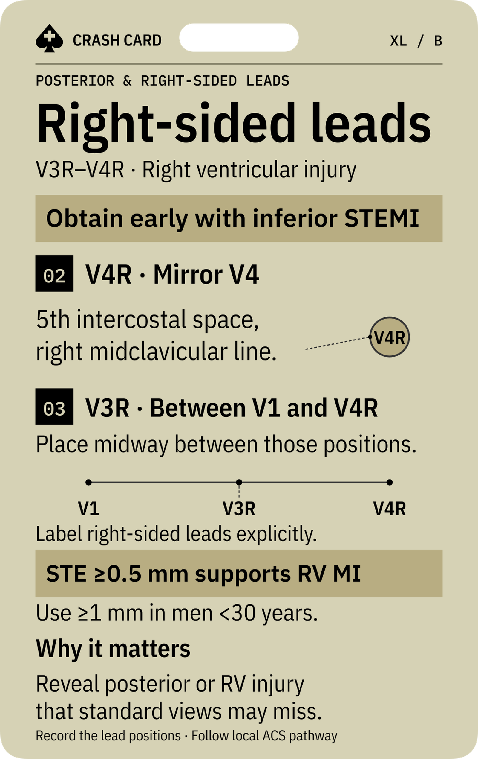 Posterior & Right-sided Leads — back: Why extra views can reveal injury missed by standard leads