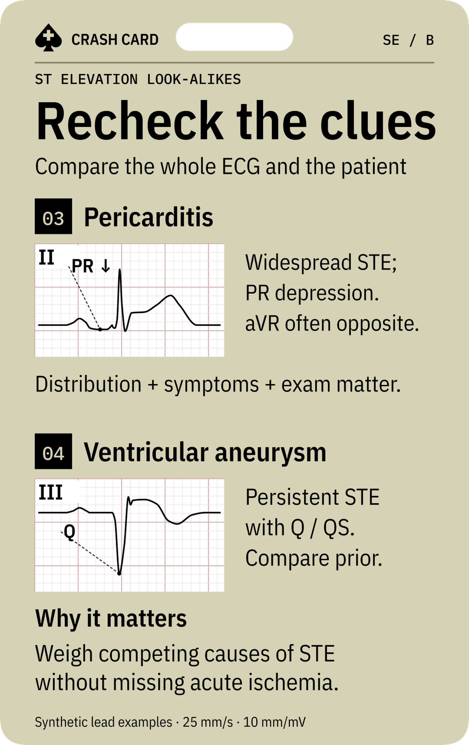 ST Elevation Look-alikes — back: Why competing explanations must not obscure acute ischemia