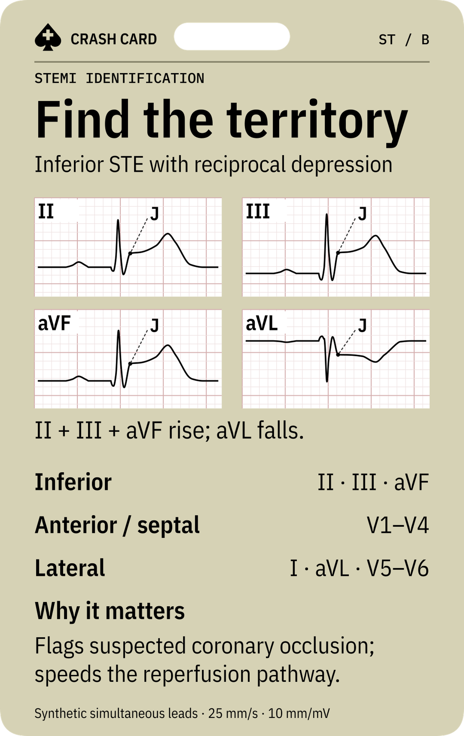 STEMI Identification — back: Why recognition speeds the suspected occlusion pathway