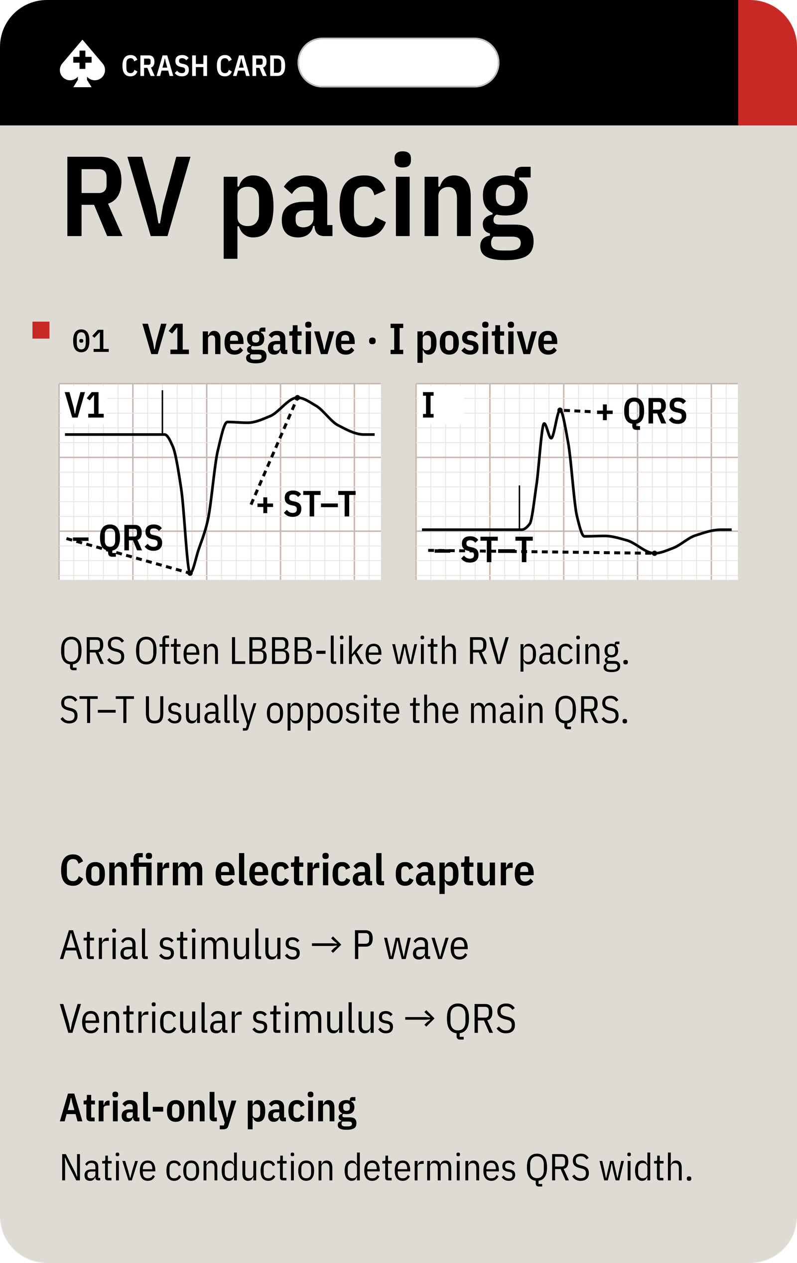 Paced Rhythm Recognition — back: Electrical capture guide and a modified Sgarbossa cross-reference for suspected ACS