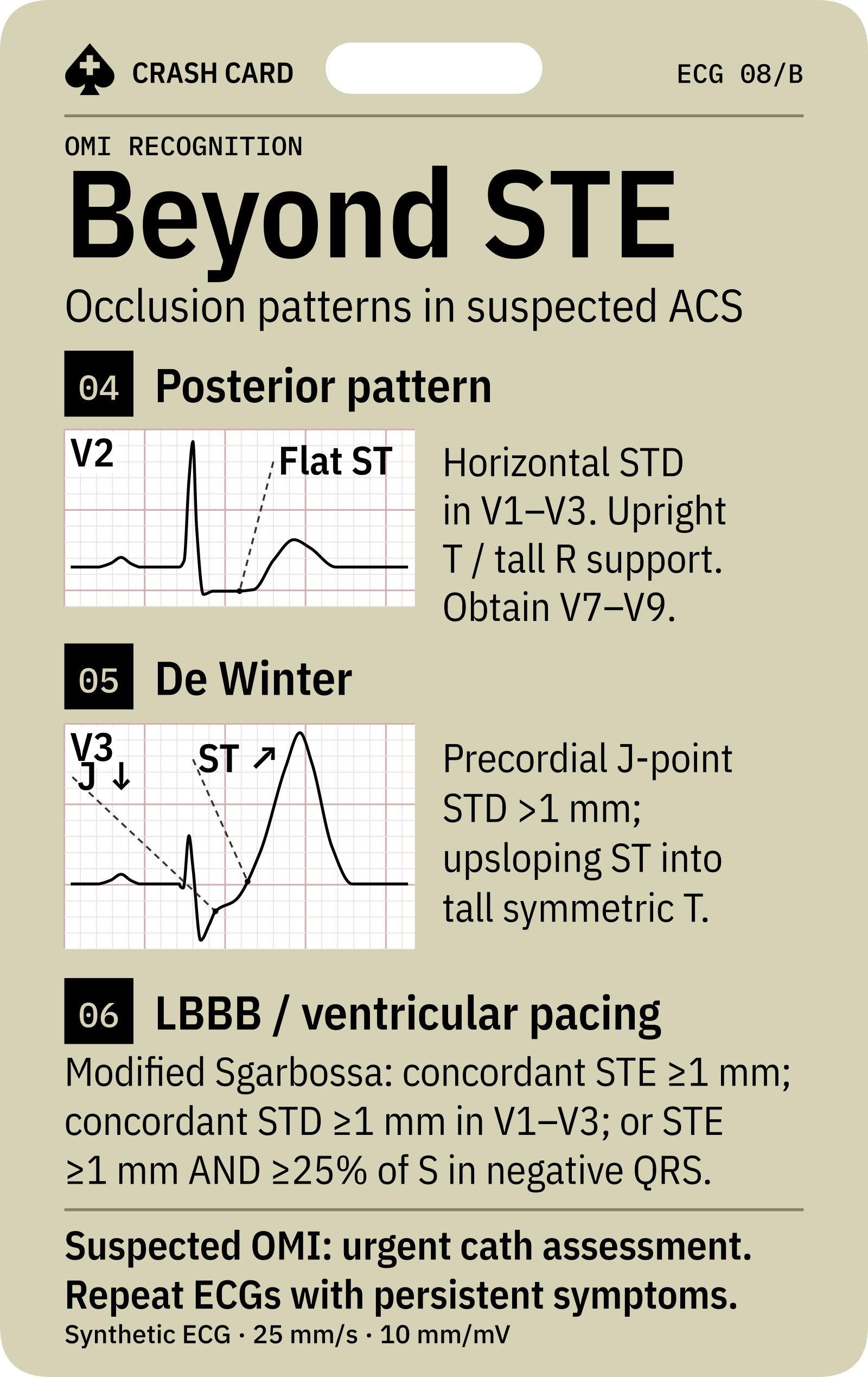 Posterior and de Winter patterns with a modified Sgarbossa reminder