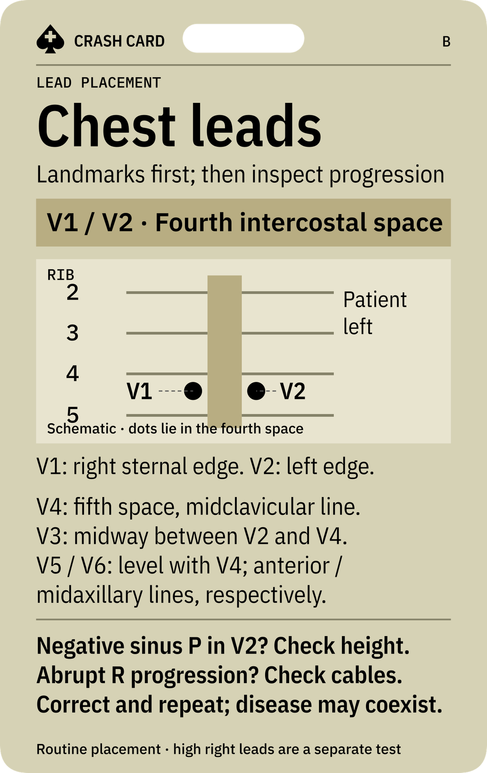 Lead Placement & Reversal — back: Why lead errors can be mistaken for infarction