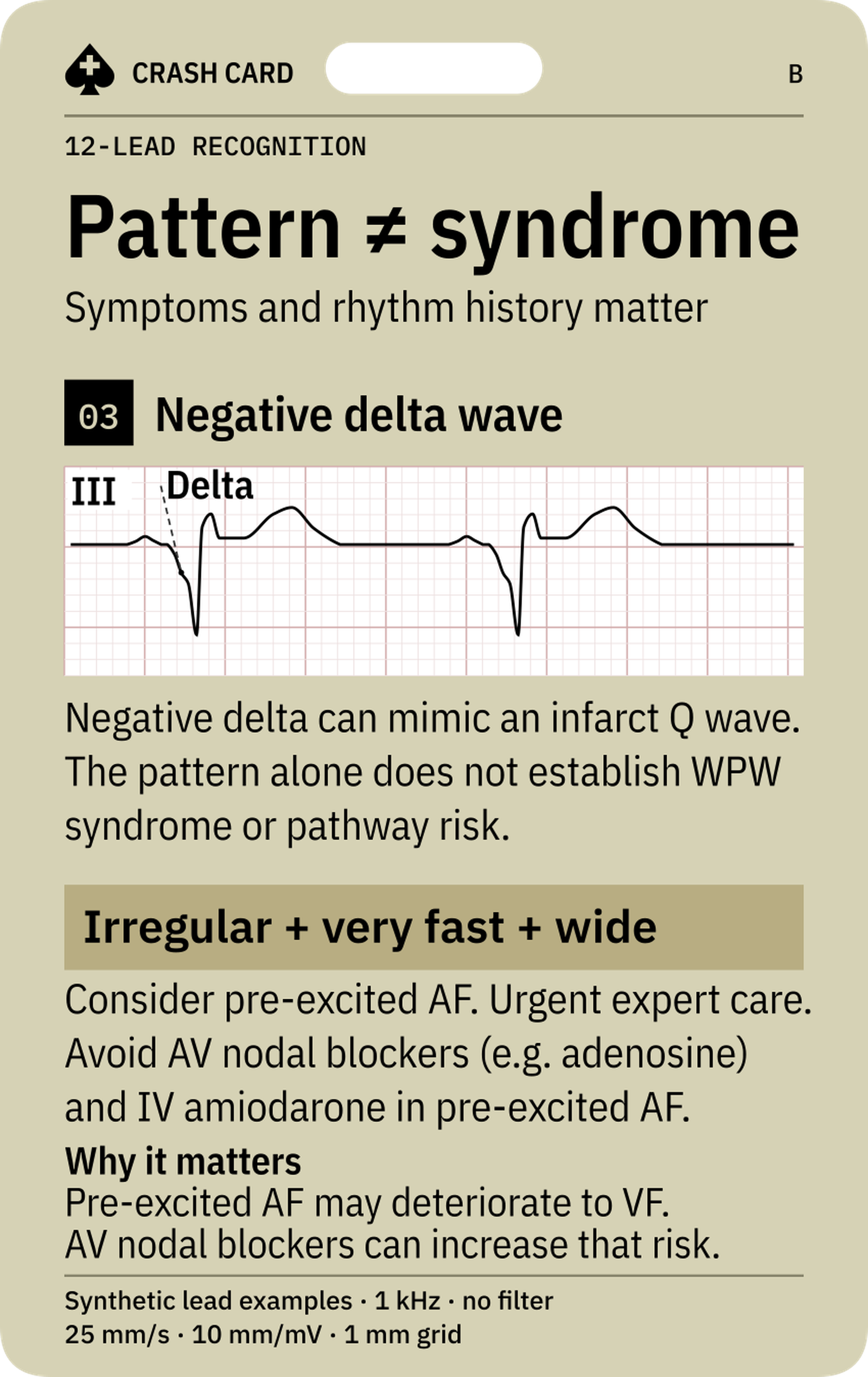 Pre-excitation Recognition — back: Why AV nodal blockers can increase risk in pre-excited AF